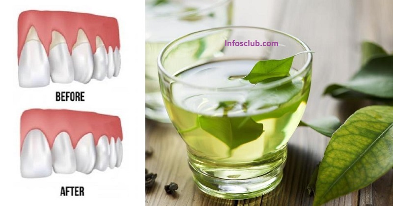 15 Easy Ways to Reverse Receding Gums Naturally in 2024
